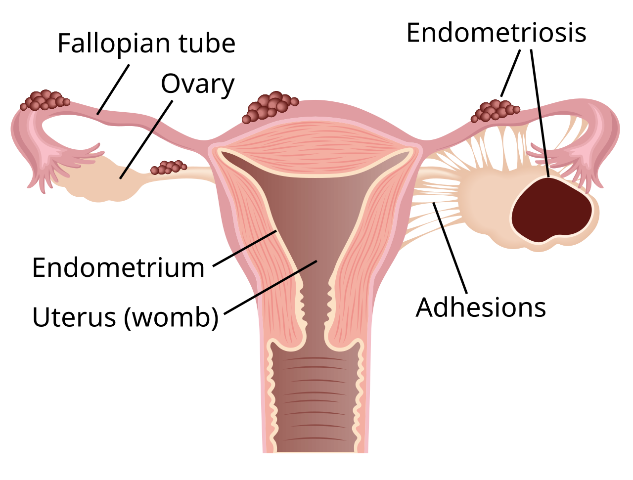 Endometriosis Symptoms & Diagnosis: Your Guide to Treatment Options
